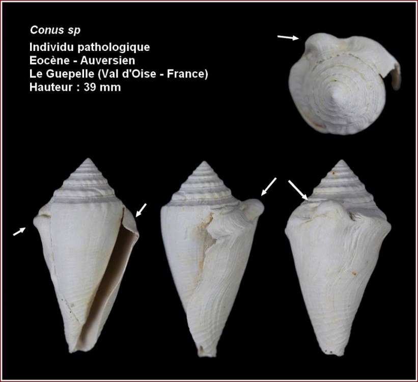 conus_pathologique.jpg